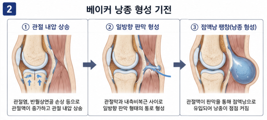 베이커 낭종 일방향 판막 형성 기전 도해