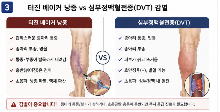 터진 베이커 낭종과 심부정맥혈전증 감별 비교