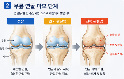 무릎 연골 마모 단계별 도해