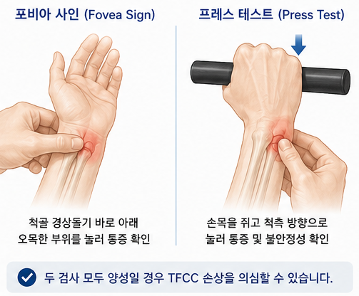 TFCC 진찰 검사 포비아 사인과 프레스 테스트 시범