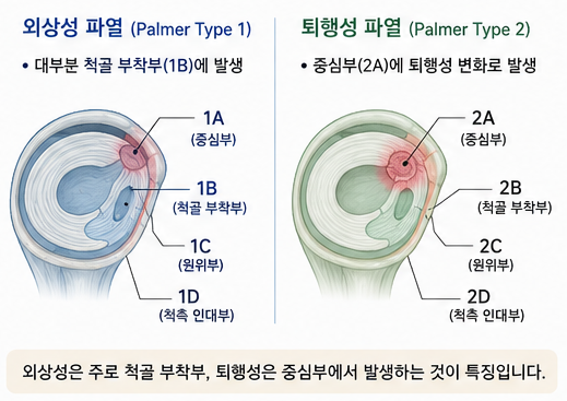 TFCC Palmer 분류 외상성 퇴행성 파열 위치 도식